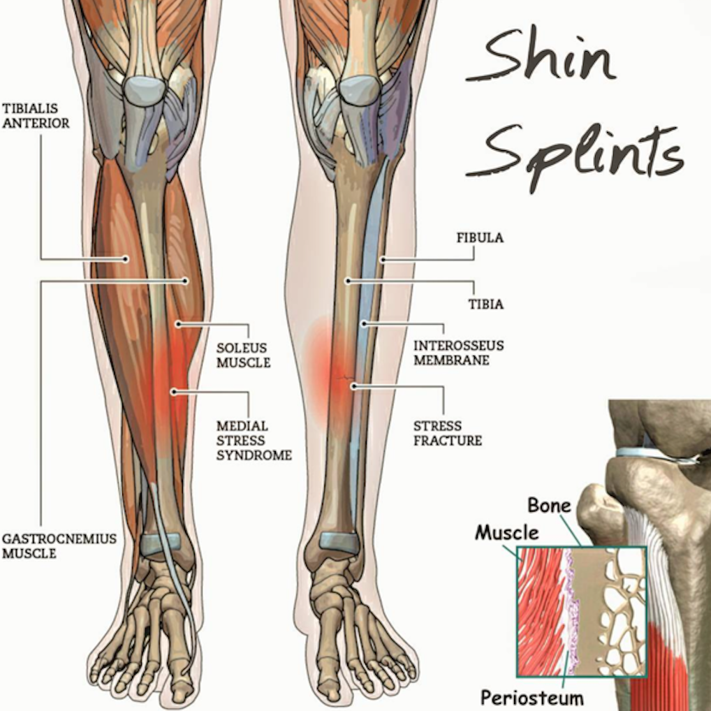 shin-splint-treatment-melbourne-shin-splint-massage-rehab